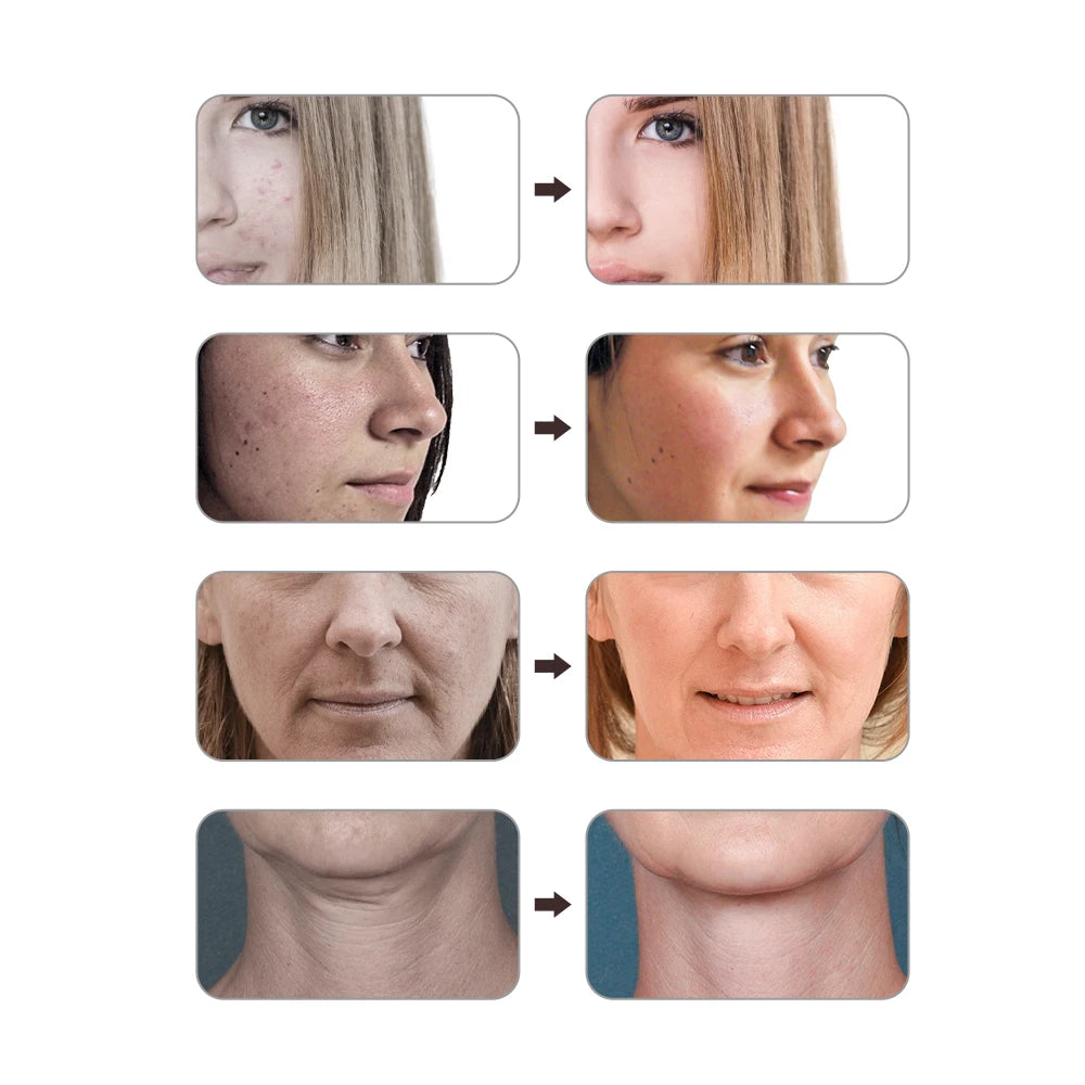 Máscara LED Rejuvenecedora para el Rostro